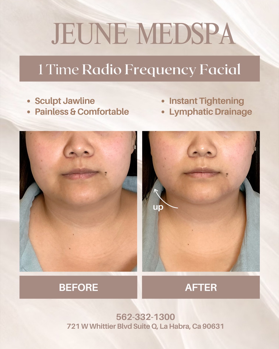 Radio Frequency Facial — 1 Session — before and after at Jeune Medspa La Habra
