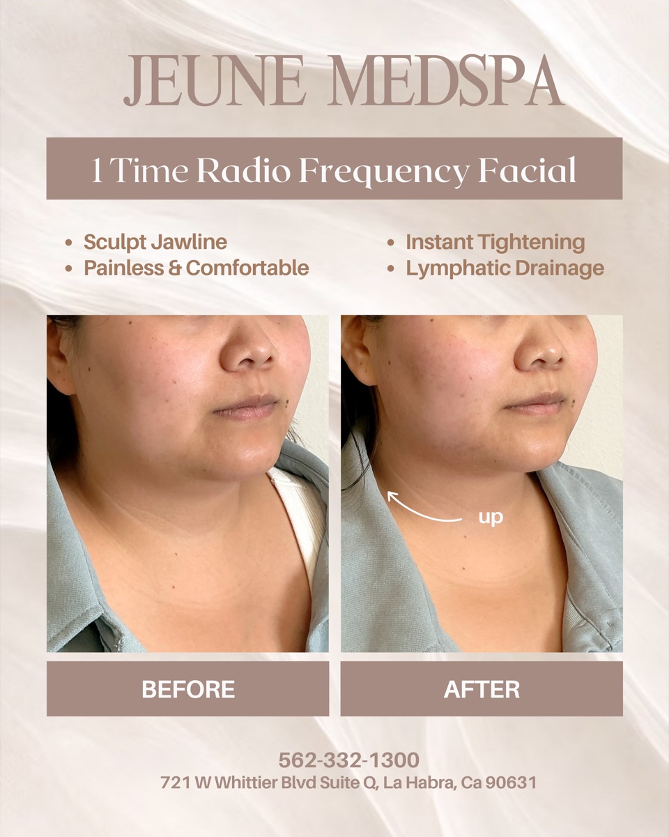 Radio Frequency Facial — 1 Session — before and after at Jeune Medspa La Habra
