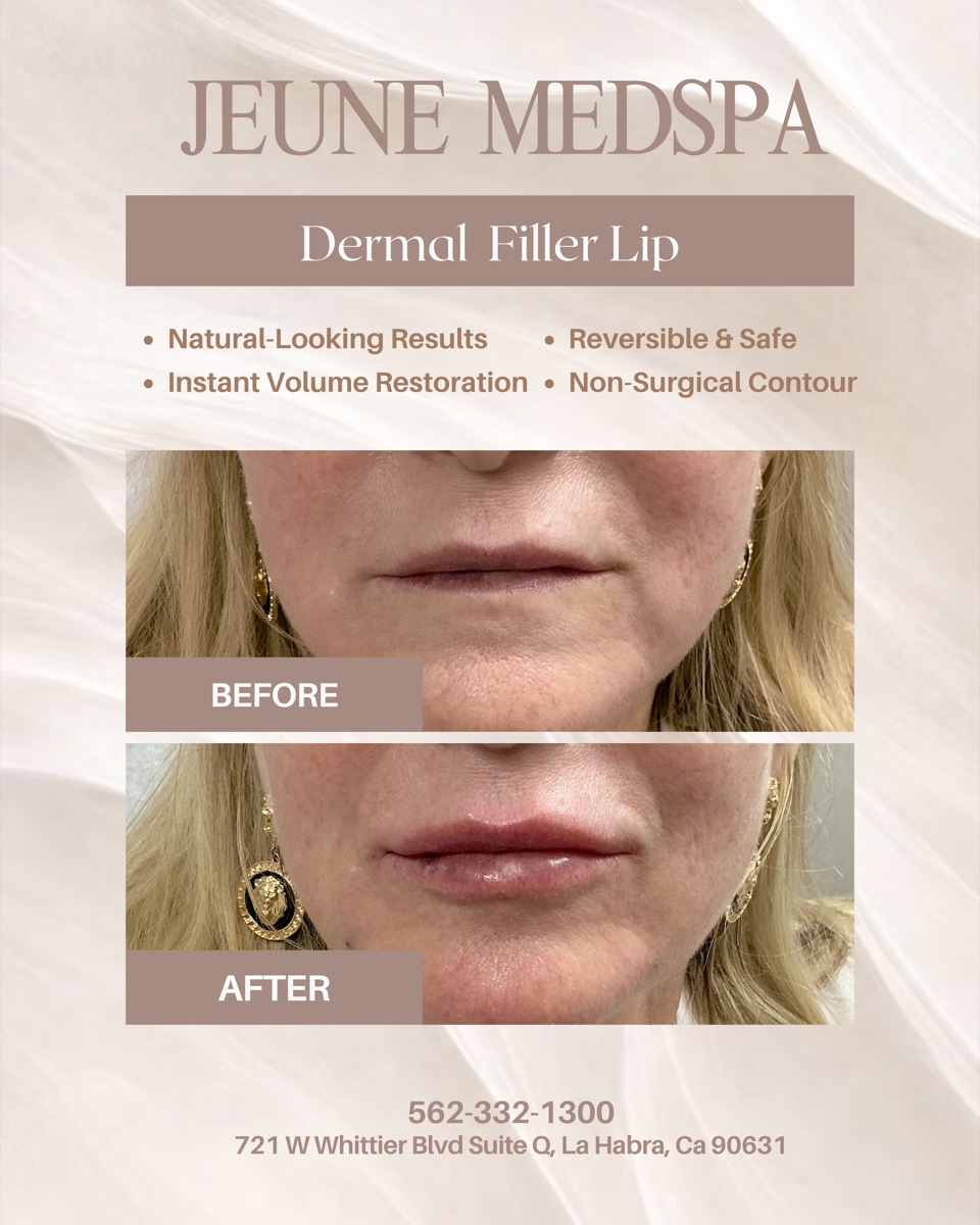 Dermal Filler — Lips — before and after at Jeune Medspa La Habra