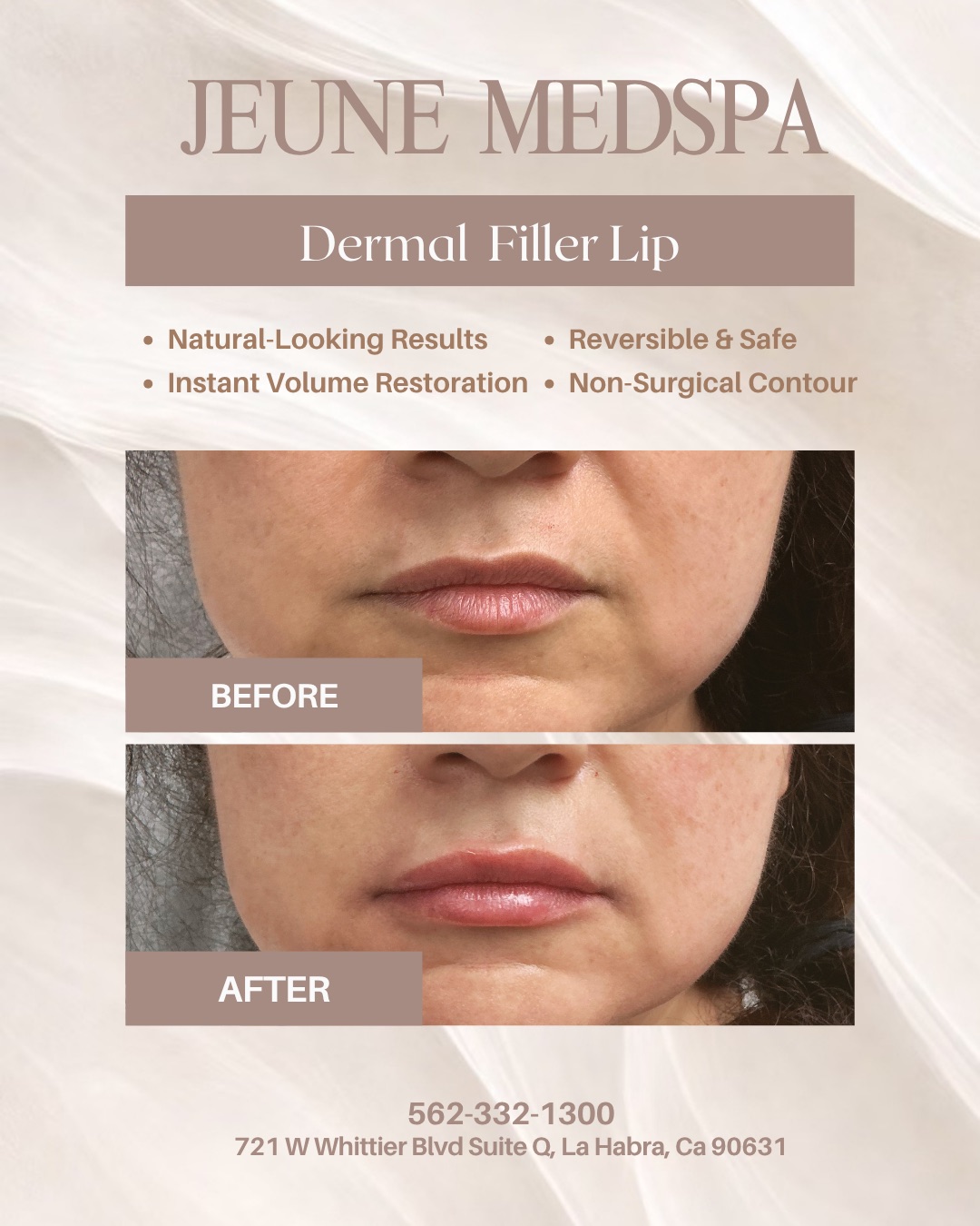 Dermal Filler — Lips — before and after at Jeune Medspa La Habra