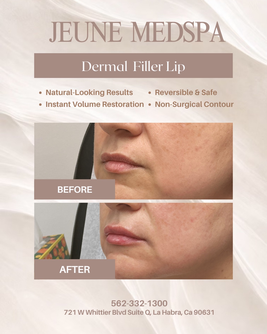 Dermal Filler — Lips — before and after at Jeune Medspa La Habra