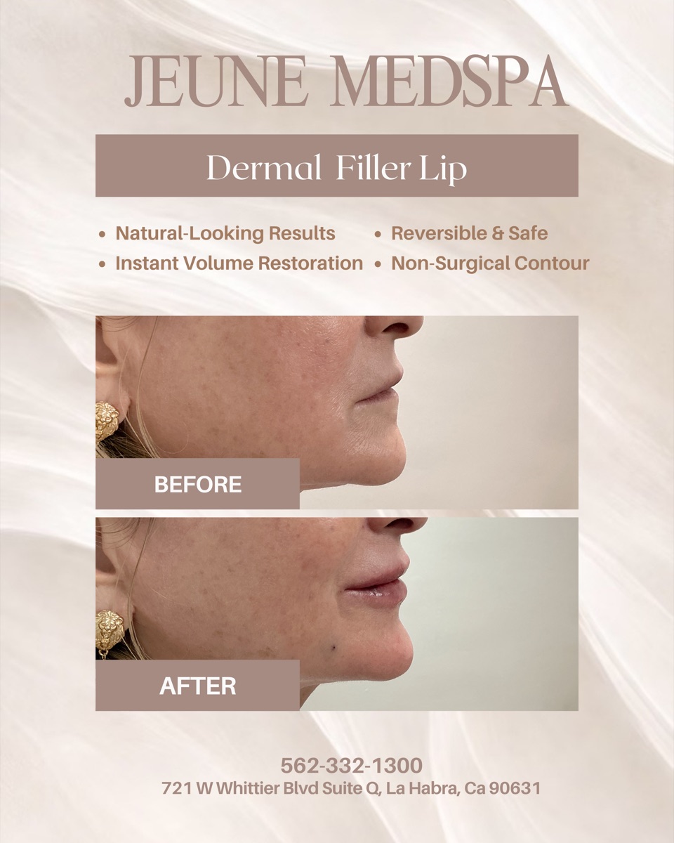 Dermal Filler — Lips — before and after at Jeune Medspa La Habra