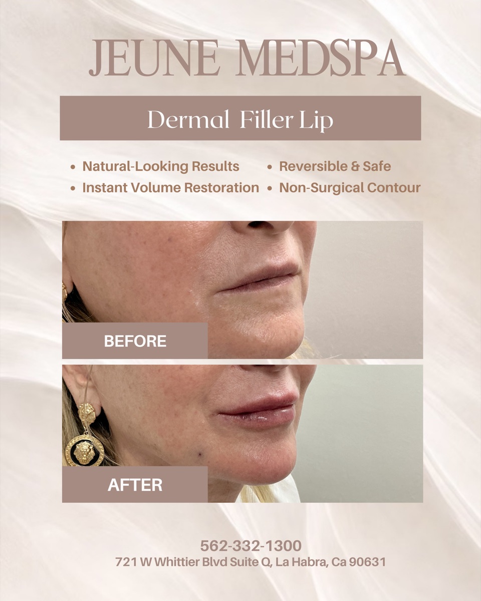 Dermal Filler — Lips — before and after at Jeune Medspa La Habra
