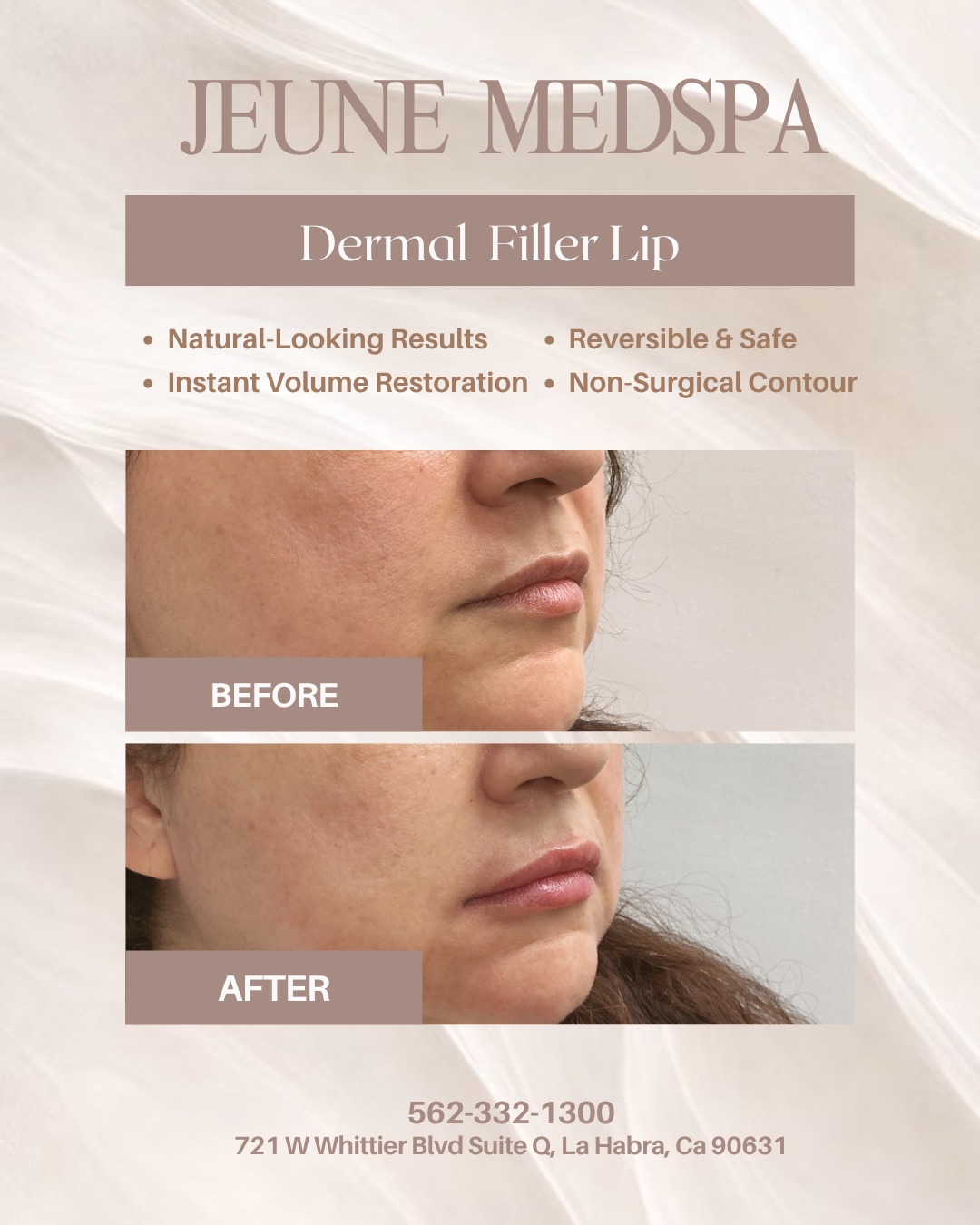 Dermal Filler — Lips — before and after at Jeune Medspa La Habra