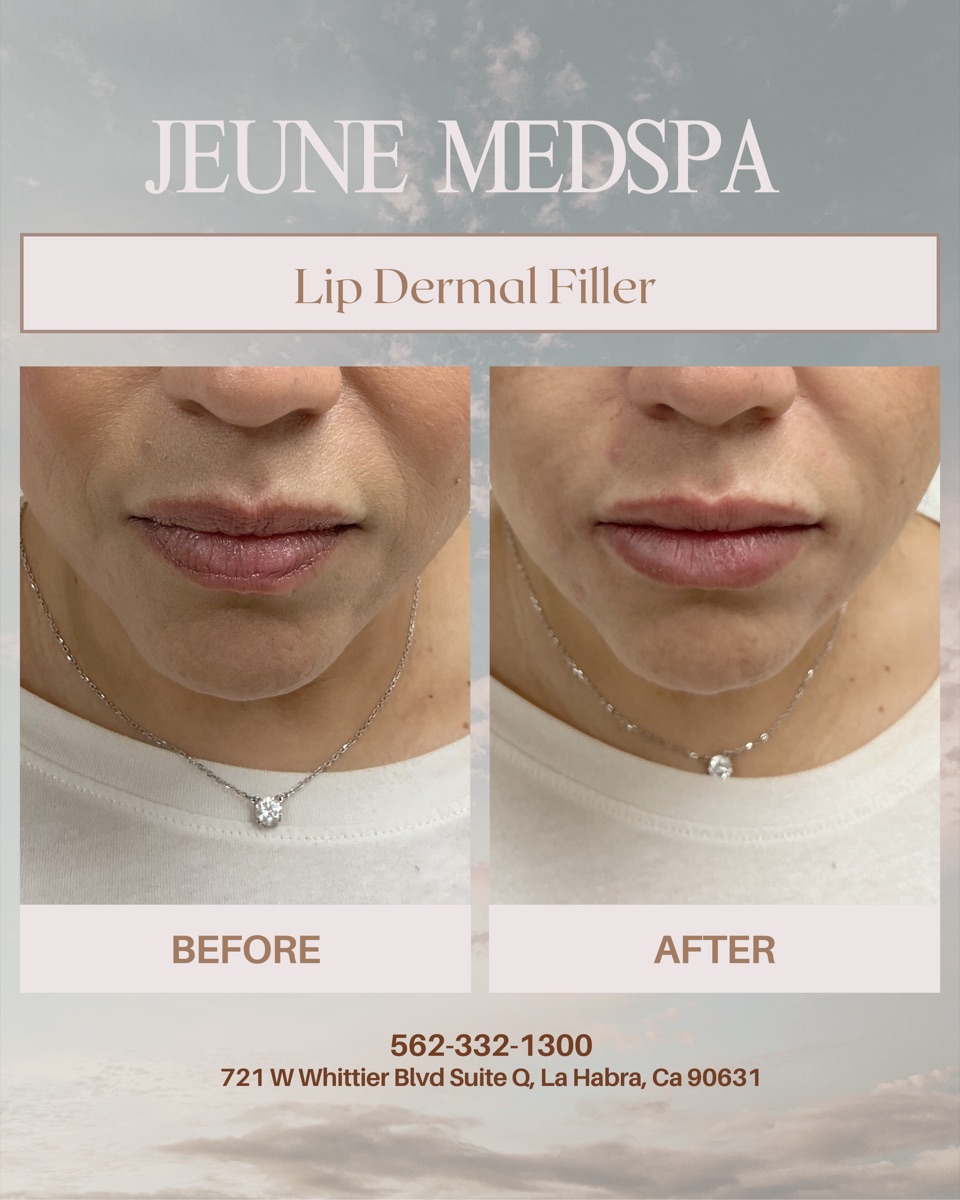 Lip Dermal Filler — before and after at Jeune Medspa La Habra