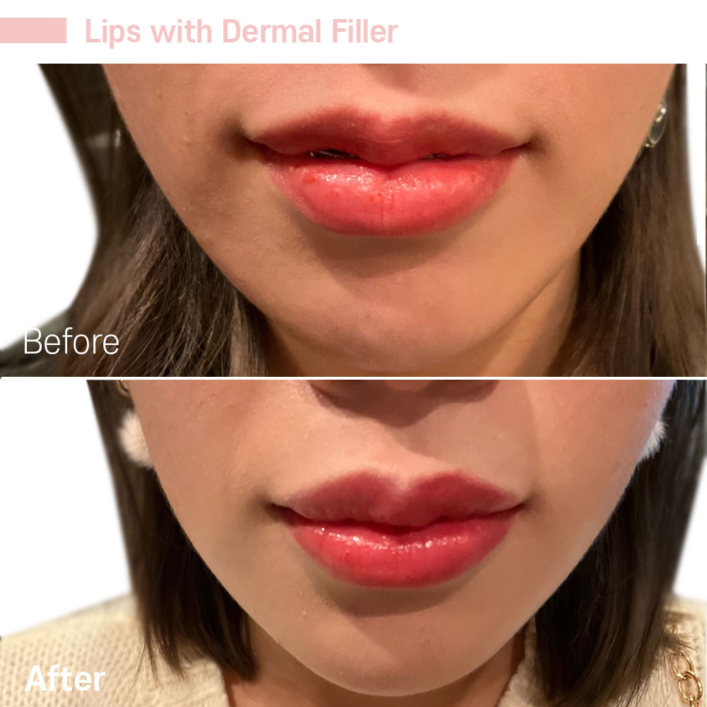 Lips with Dermal Filler — before and after at Jeune Medspa La Habra
