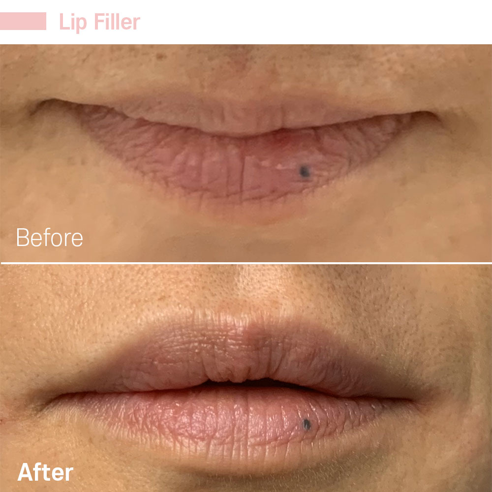 Lip Filler — before and after at Jeune Medspa La Habra