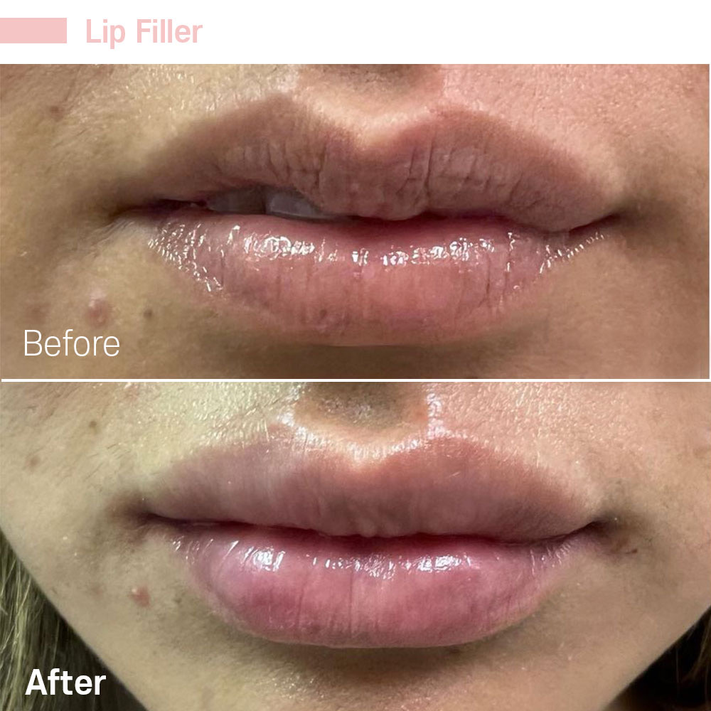 Lip Filler — before and after at Jeune Medspa La Habra