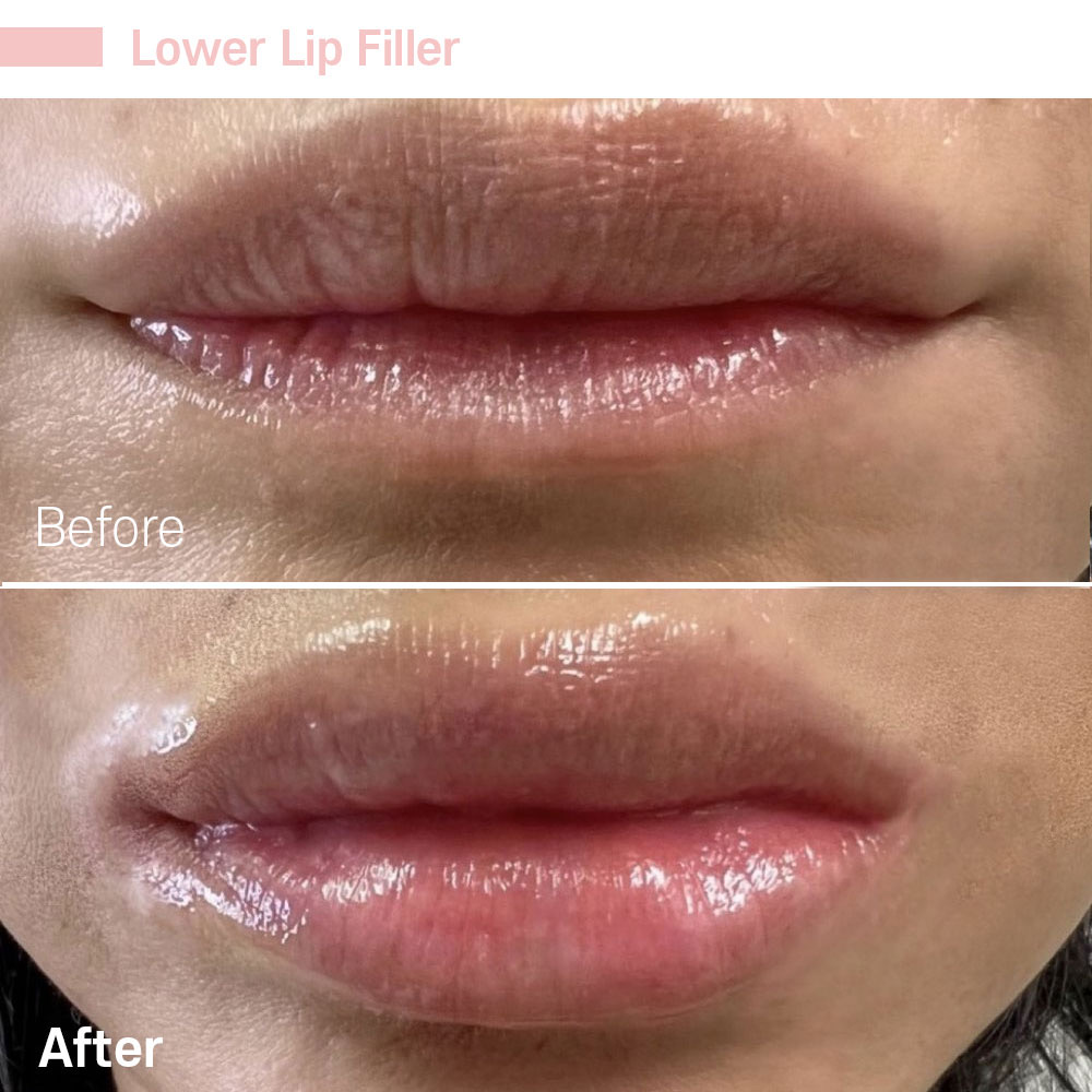 Lower Lip Filler — before and after at Jeune Medspa La Habra