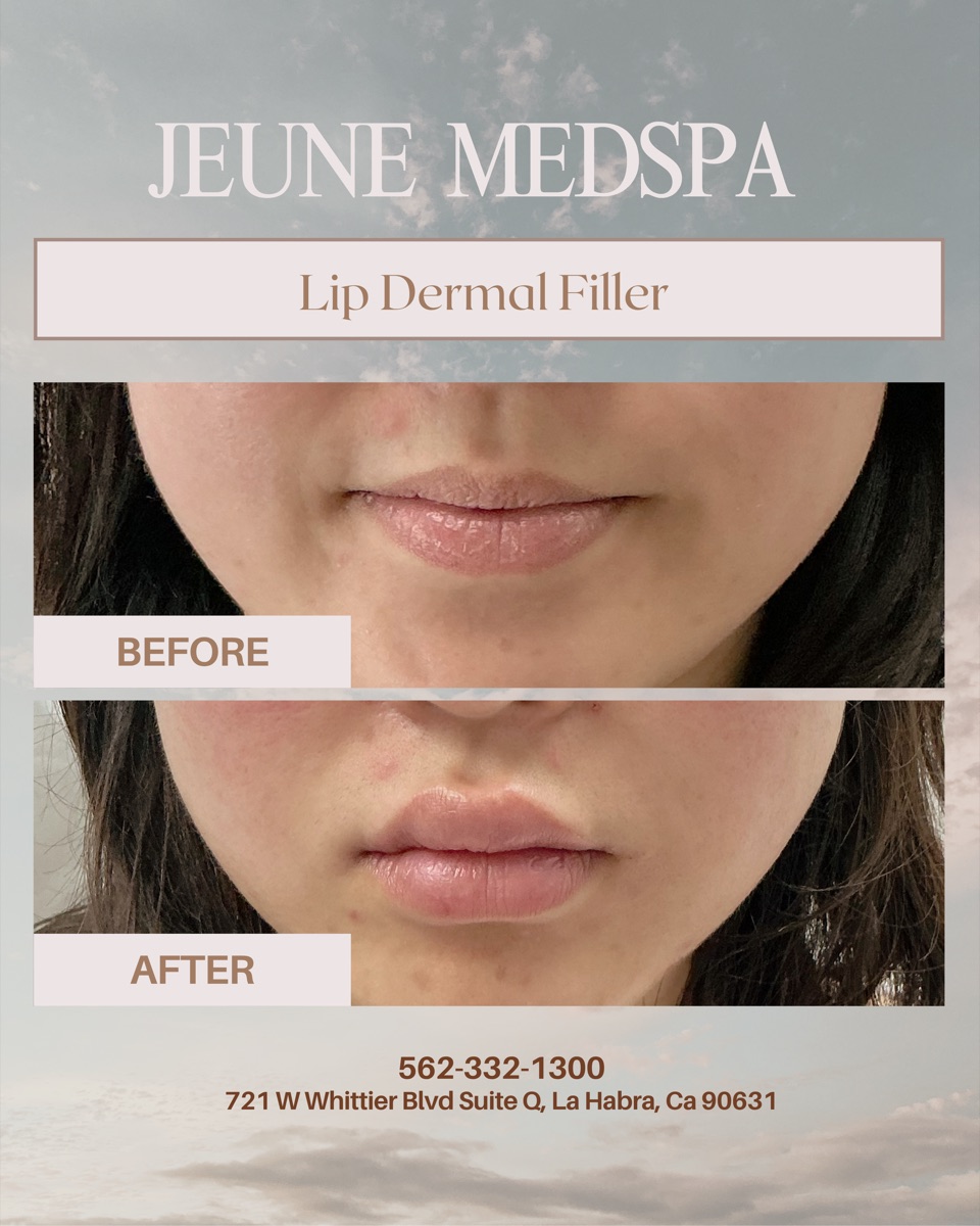 Lip Dermal Filler — before and after at Jeune Medspa La Habra