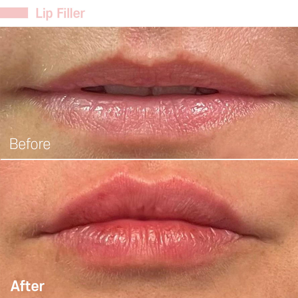 Lip Filler — before and after at Jeune Medspa La Habra