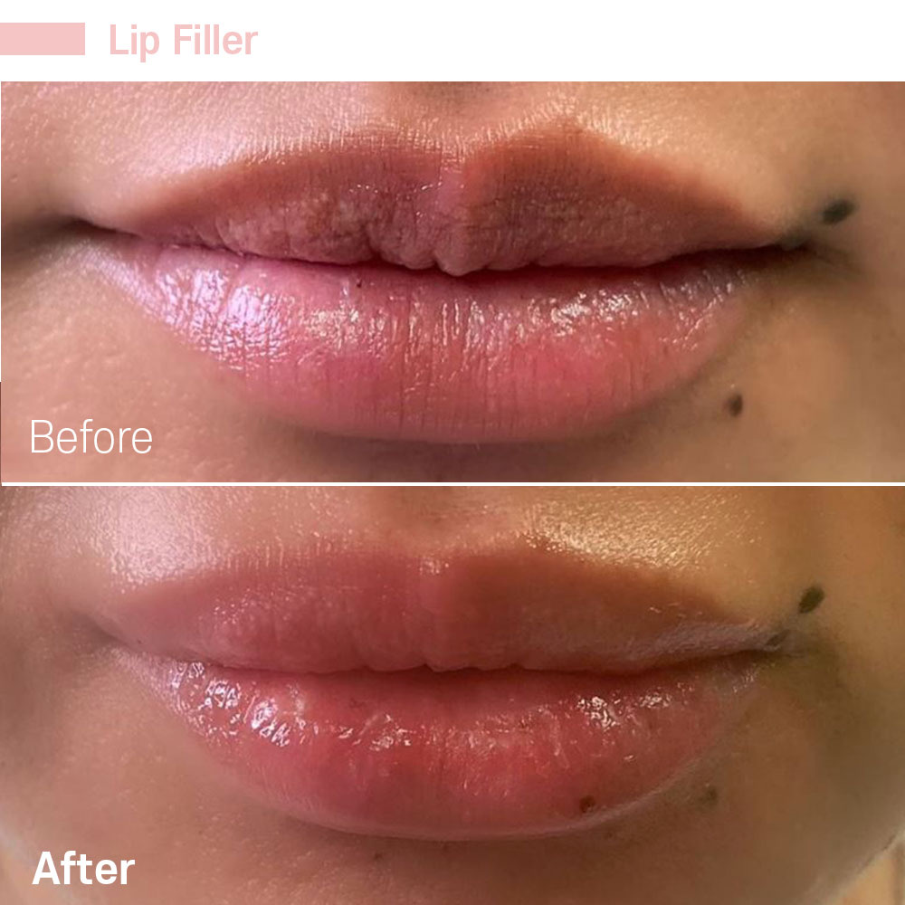 Lip Filler — before and after at Jeune Medspa La Habra