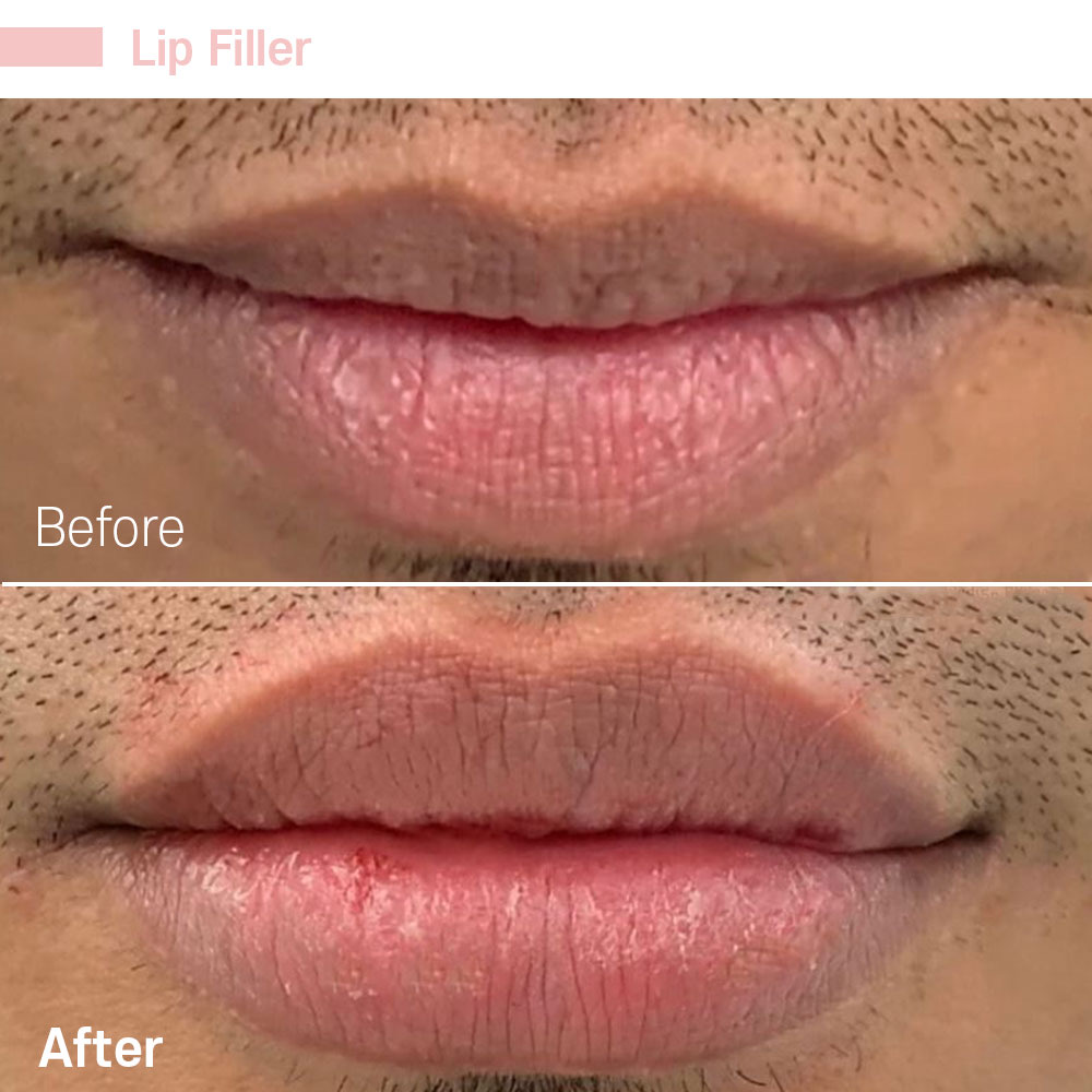 Lip Filler — before and after at Jeune Medspa La Habra