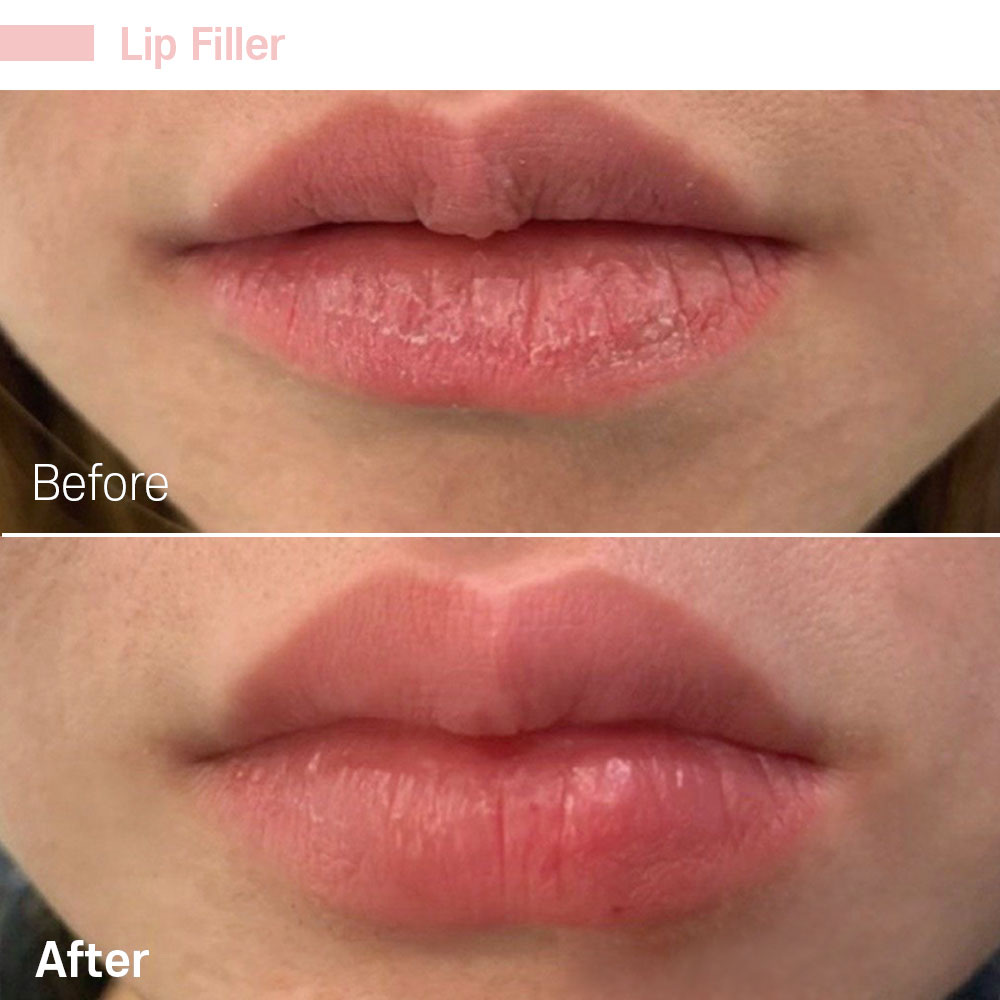 Lip Filler — before and after at Jeune Medspa La Habra