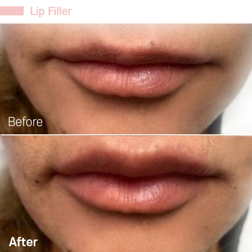 Lip Filler — before and after at Jeune Medspa La Habra