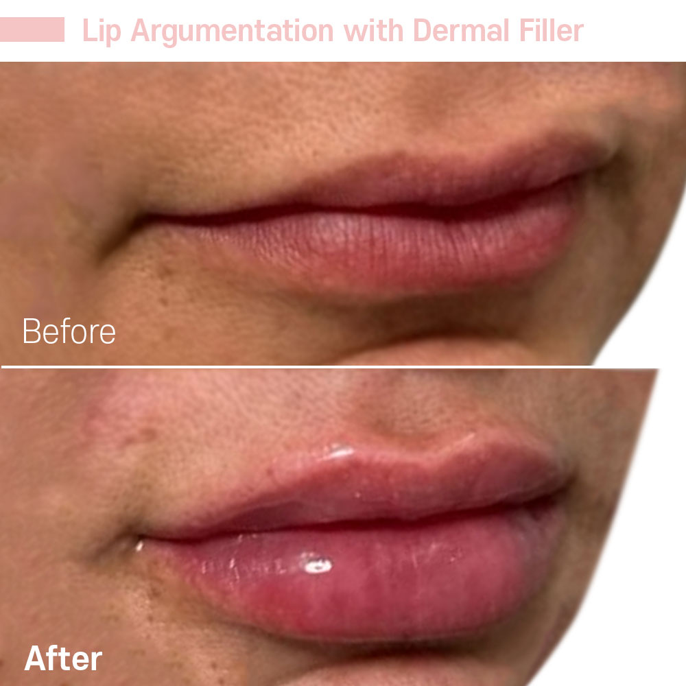 Lip Augmentation with Dermal Filler — before and after at Jeune Medspa La Habra