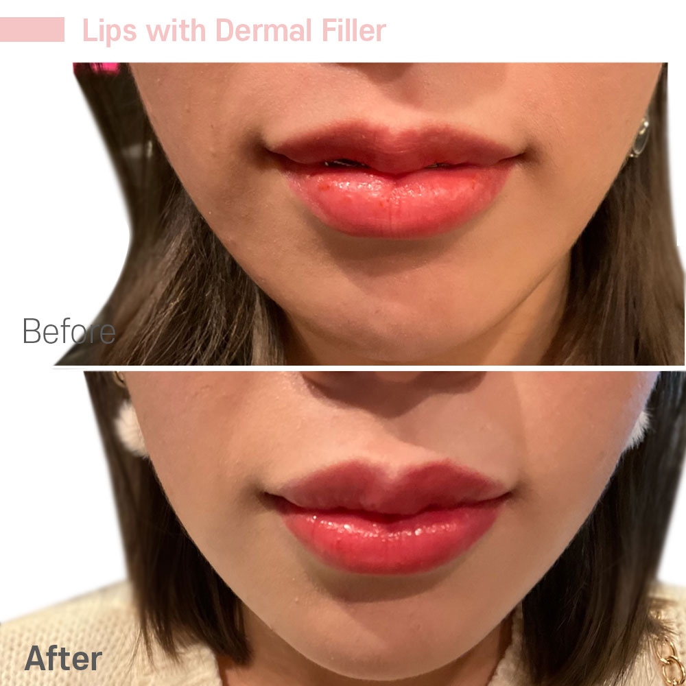 Lips with Dermal Filler — before and after at Jeune Medspa La Habra