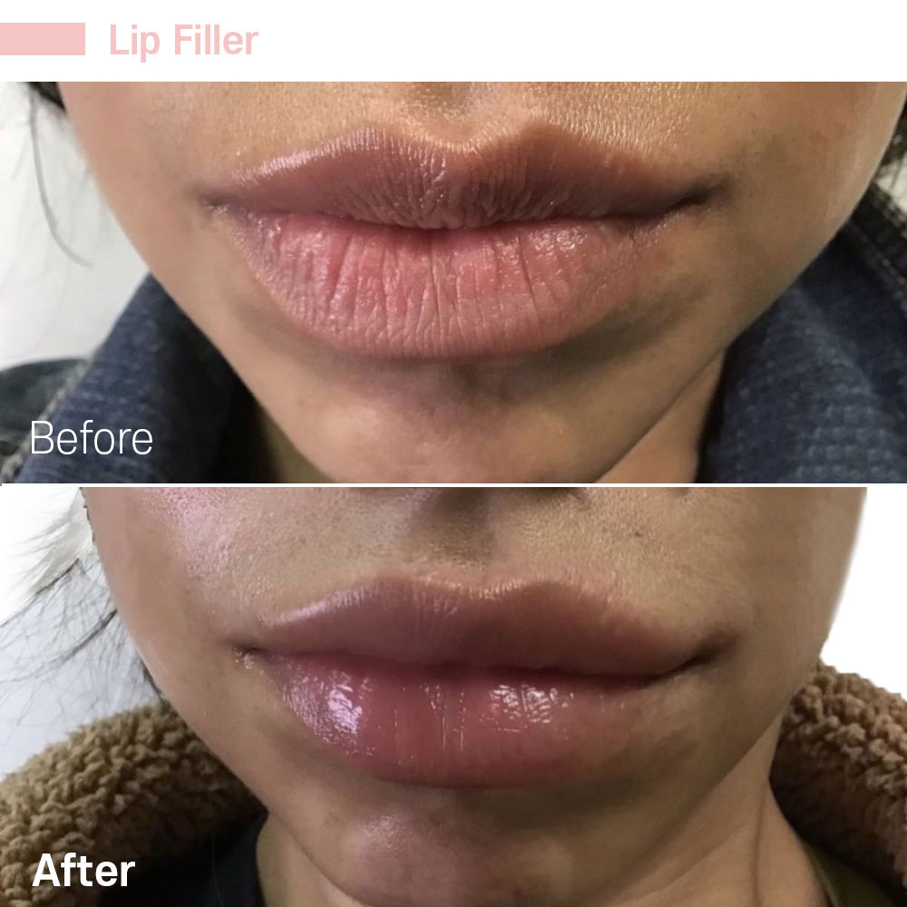 Lip Filler — before and after at Jeune Medspa La Habra