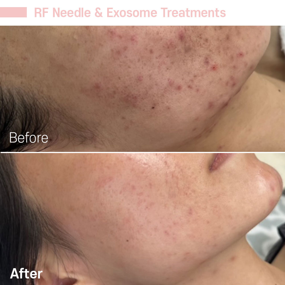 RF Needle & Exosome Treatments — before and after at Jeune Medspa La Habra