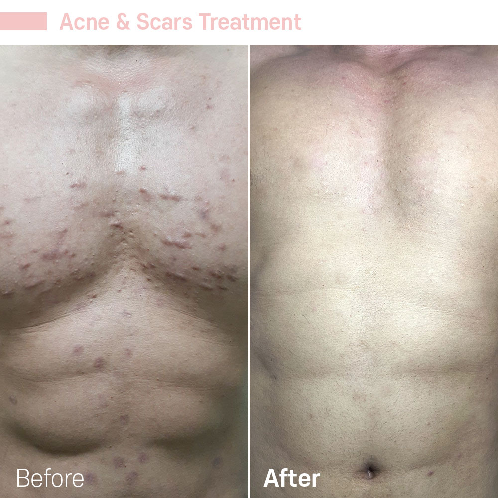 Acne & Scars Treatment — before and after at Jeune Medspa La Habra