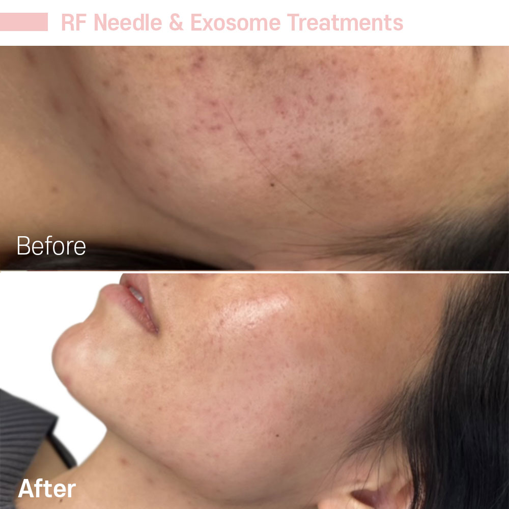 RF Needle & Exosome Treatments — before and after at Jeune Medspa La Habra