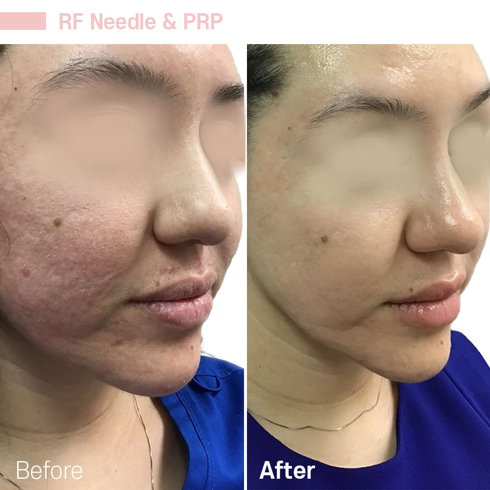 RF Needle & PRP — before and after at Jeune Medspa La Habra