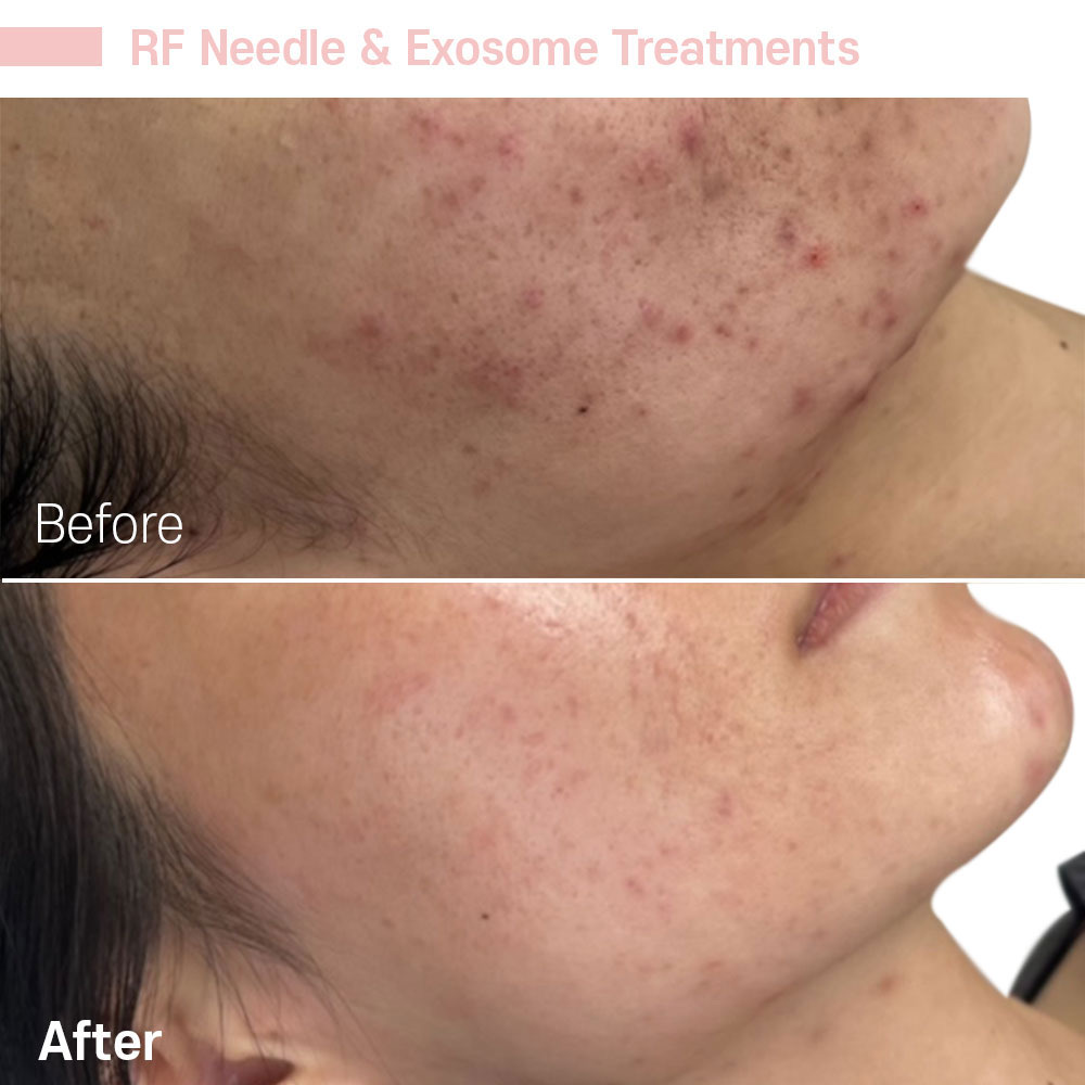 RF Needle & Exosome Treatments — before and after at Jeune Medspa La Habra