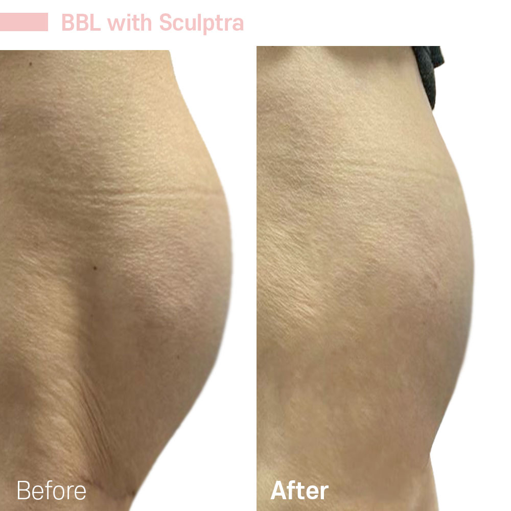 BBL with Sculptra — before and after at Jeune Medspa La Habra