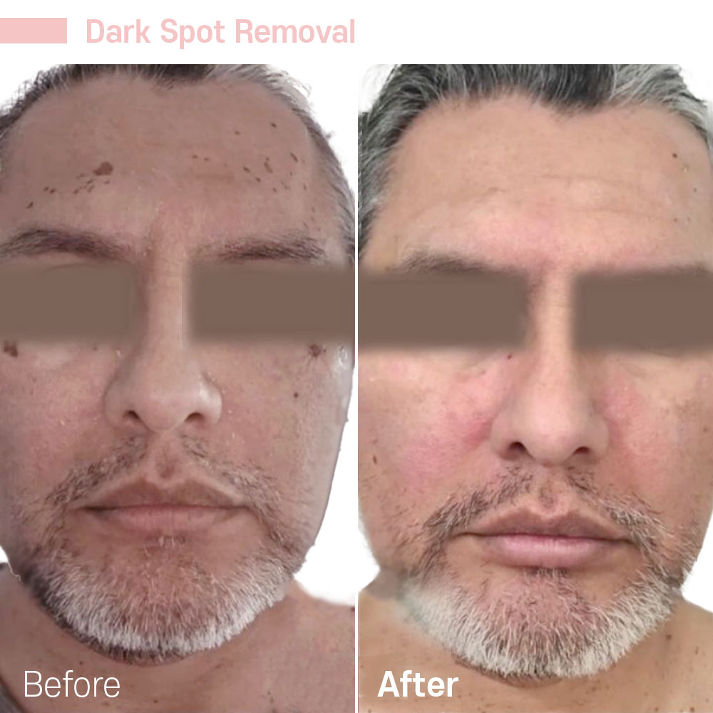 Dark Spot Removal — before and after at Jeune Medspa La Habra