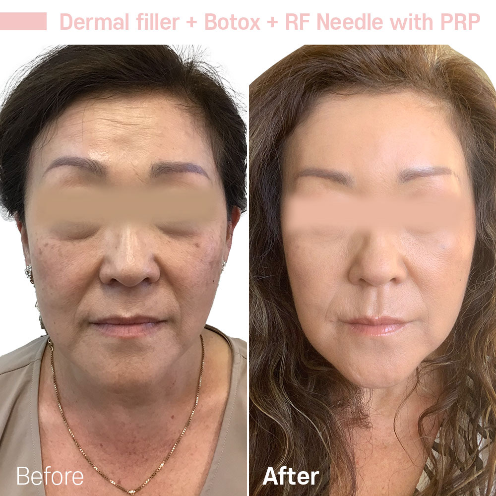 Dermal filler + Botox + RF Needle with PRP — before and after at Jeune Medspa La Habra