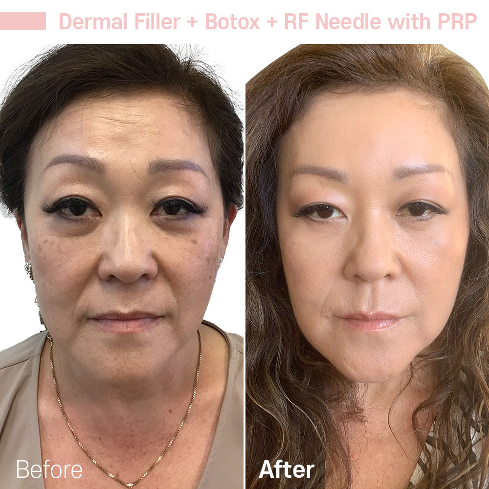 Dermal Filler + Botox + RF Needle with PRP — before and after at Jeune Medspa La Habra