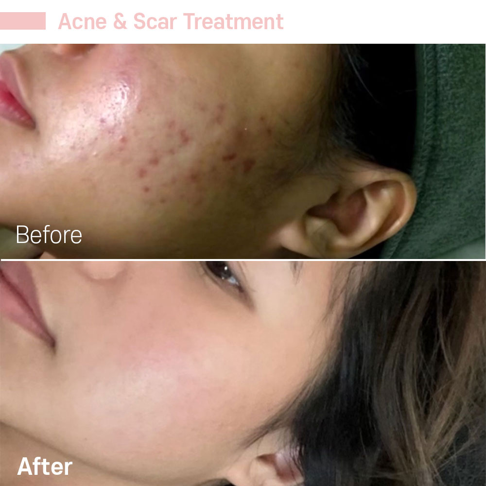Acne & Scar Treatment — before and after at Jeune Medspa La Habra