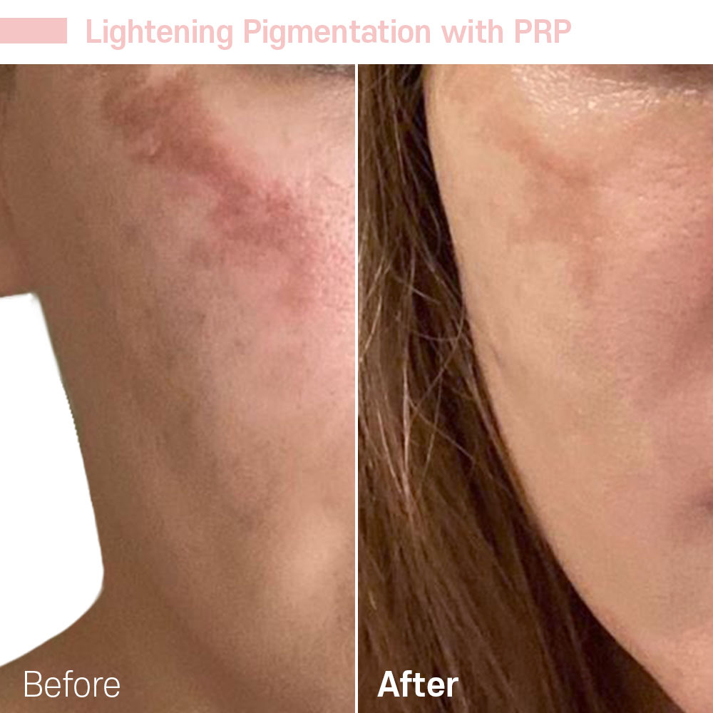 Lightening Pigmentation with PRP — before and after at Jeune Medspa La Habra