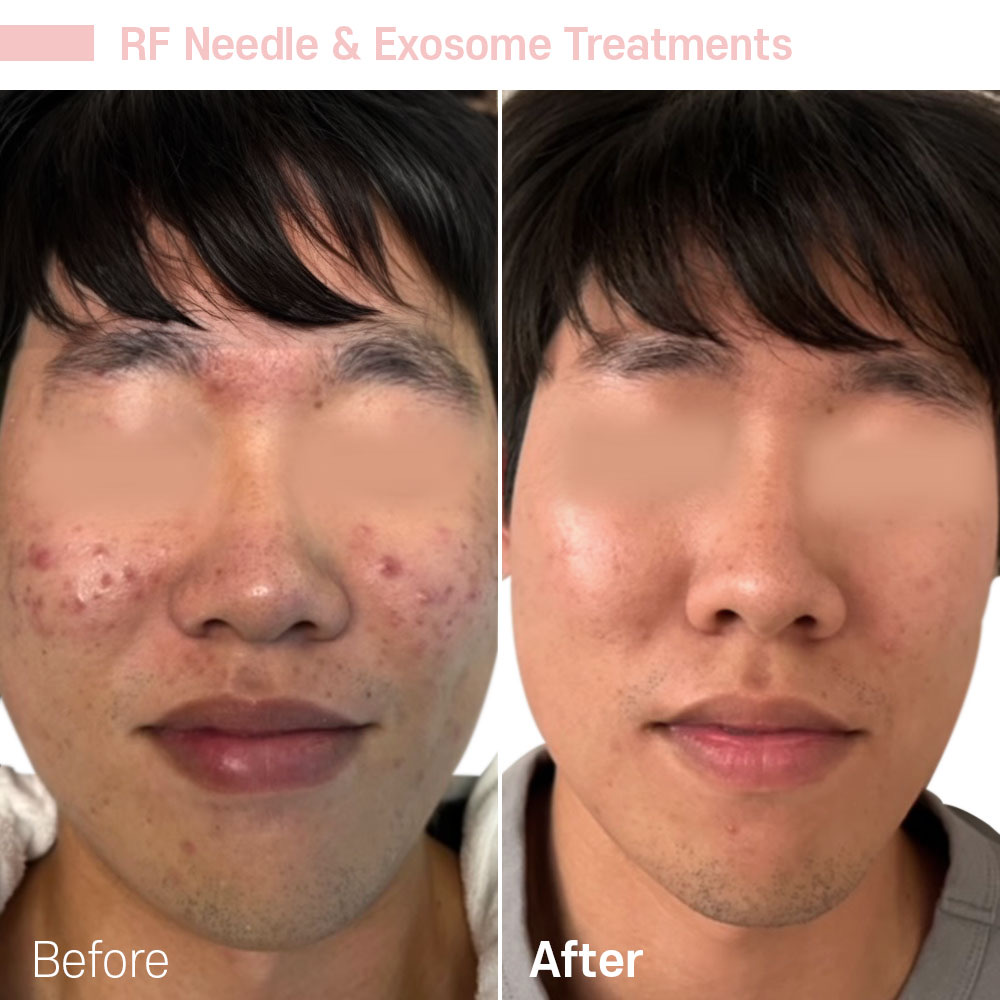 RF Needle & Exosome Treatments — before and after at Jeune Medspa La Habra