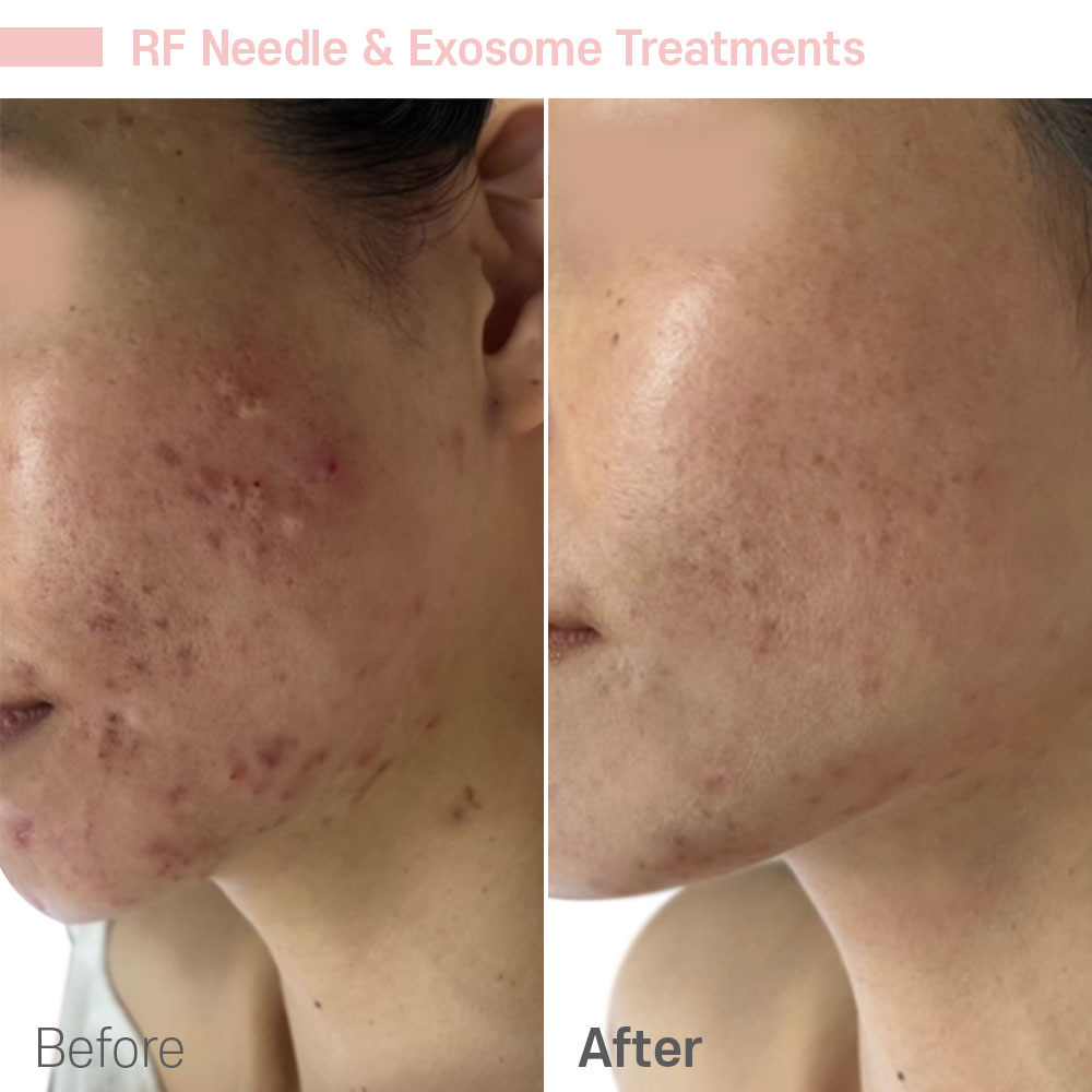 RF Needle & Exosome Treatments — before and after at Jeune Medspa La Habra
