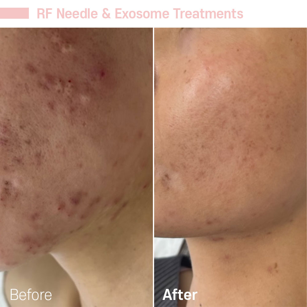 RF Needle & Exosome Treatments — before and after at Jeune Medspa La Habra
