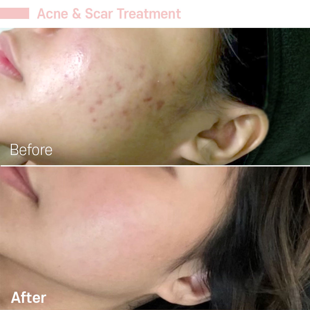 Acne & Scar Treatment — before and after at Jeune Medspa La Habra