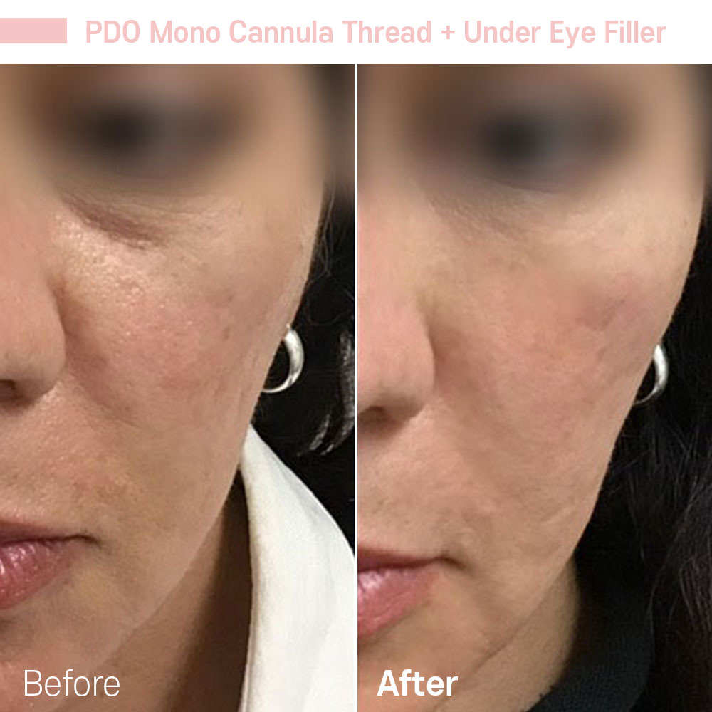 PDO Mono Cannula Thread + Under Eye Filler — before and after at Jeune Medspa La Habra
