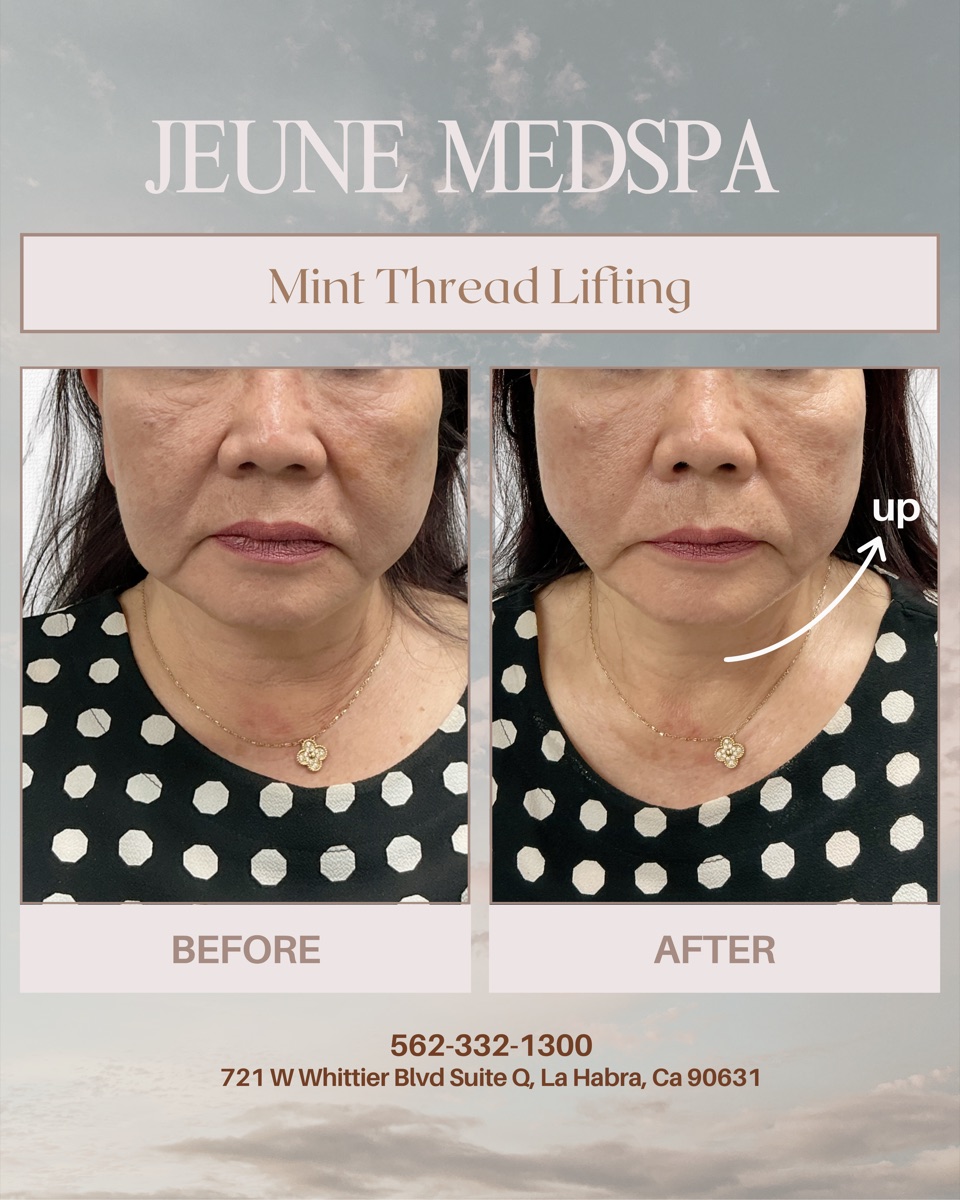 Mint Thread Lifting — before and after at Jeune Medspa La Habra