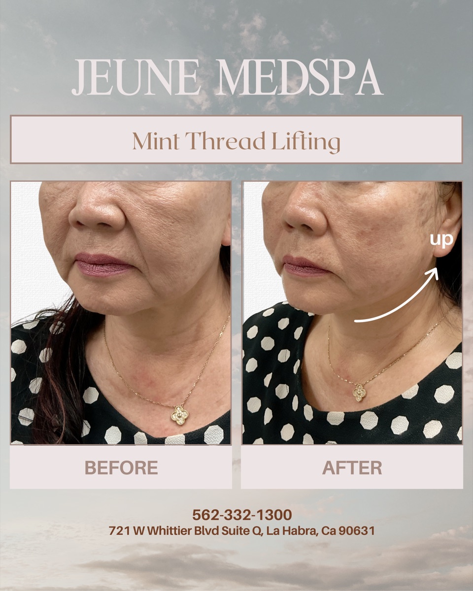 Mint Thread Lifting — before and after at Jeune Medspa La Habra
