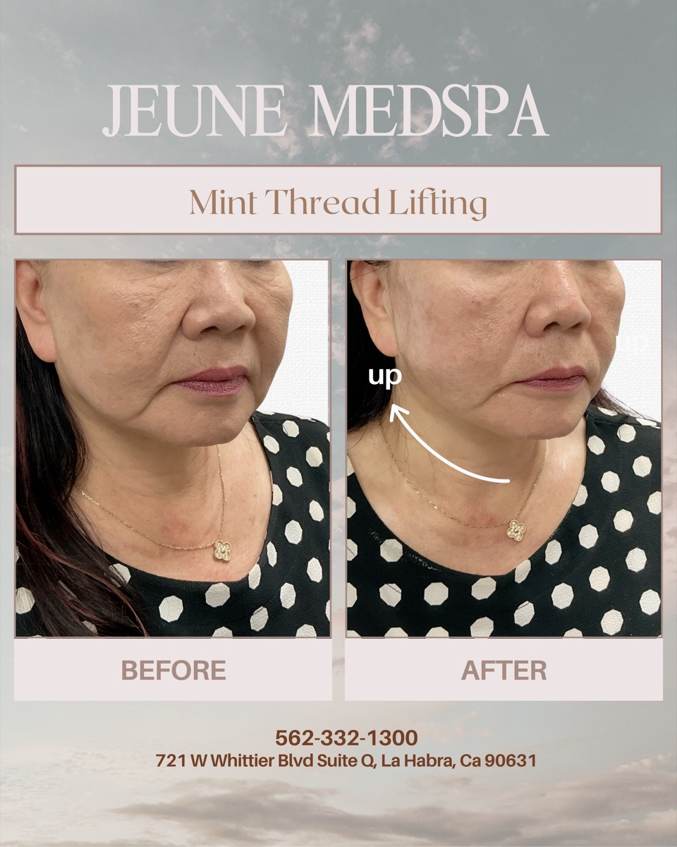 Mint Thread Lifting — before and after at Jeune Medspa La Habra