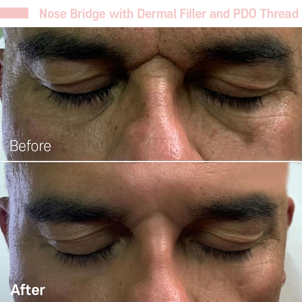 Nose Bridge with Dermal Filler and PDO Thread — before and after at Jeune Medspa La Habra