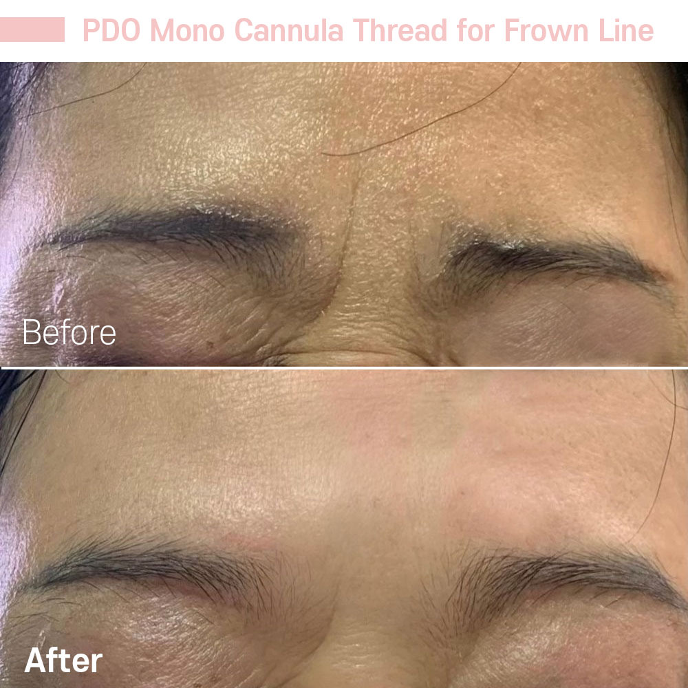 PDO Mono Cannula Thread for Frown Line — before and after at Jeune Medspa La Habra