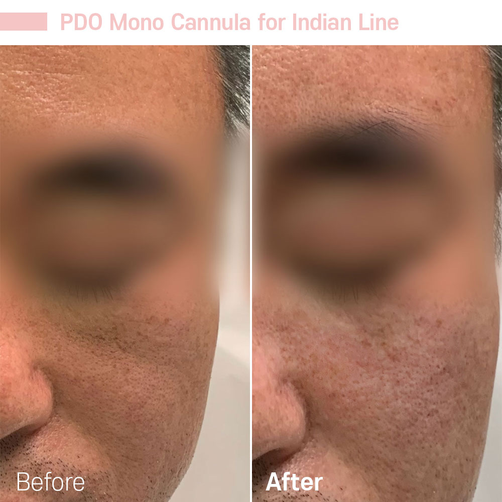 PDO Mono Cannula for Indian Line — before and after at Jeune Medspa La Habra