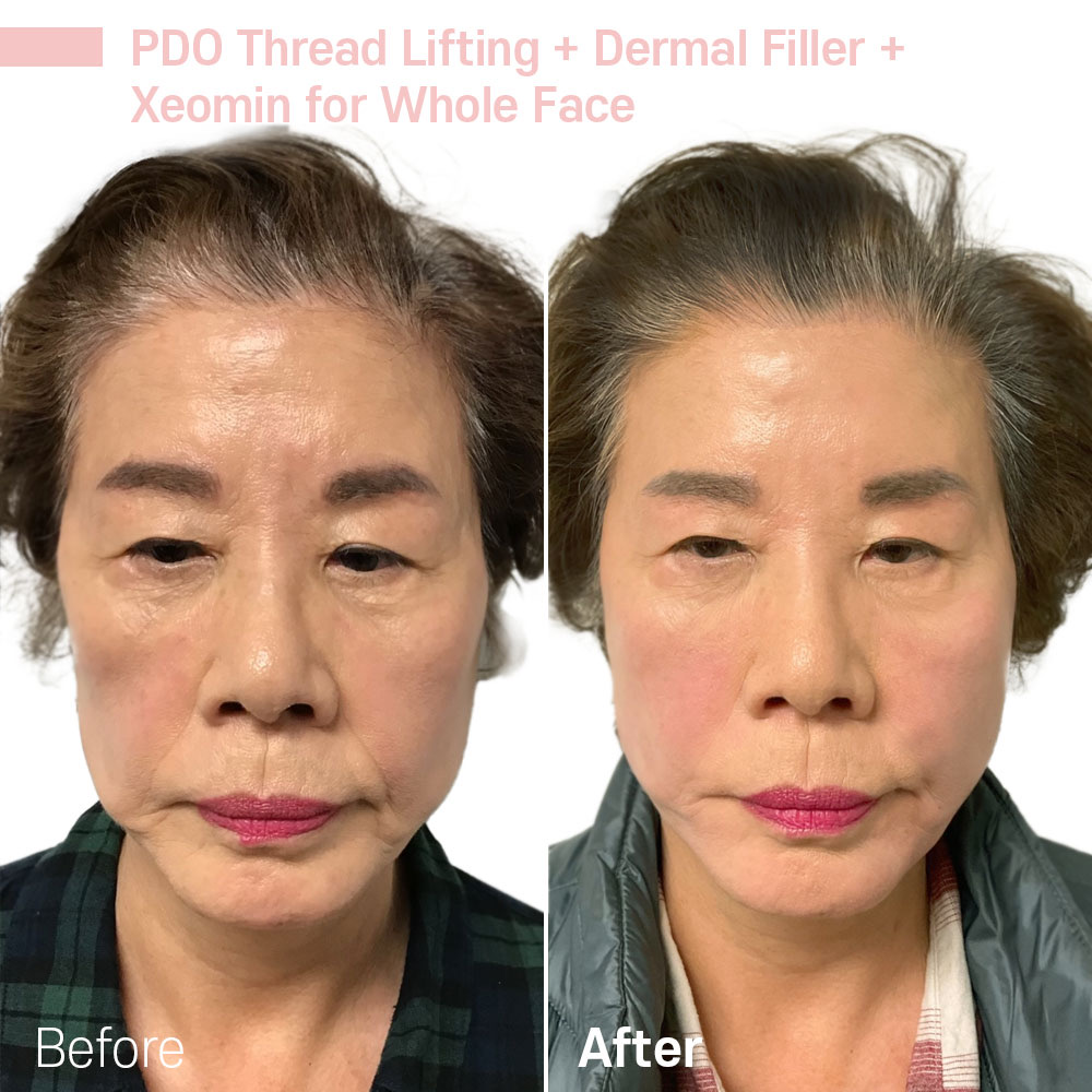 PDO Thread Lifting + Dermal Filler + Xeomin for Whole Face — before and after at Jeune Medspa La Habra