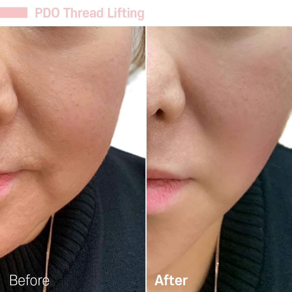 PDO Thread Lifting — before and after at Jeune Medspa La Habra