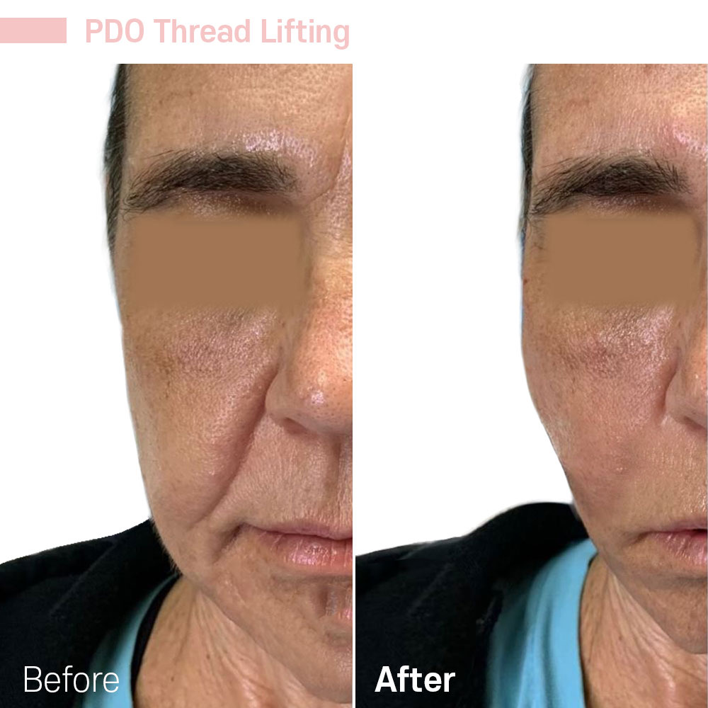PDO Thread Lifting — before and after at Jeune Medspa La Habra