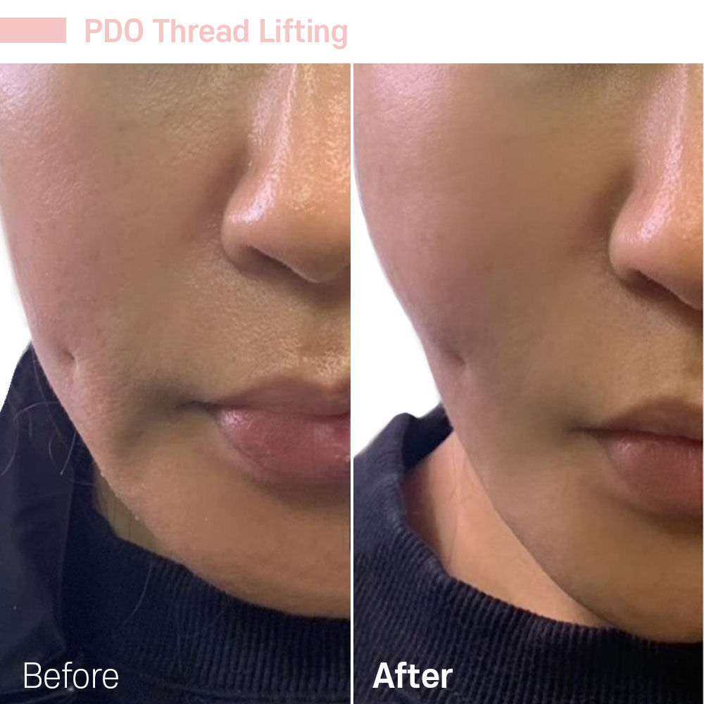 PDO Thread Lifting — before and after at Jeune Medspa La Habra