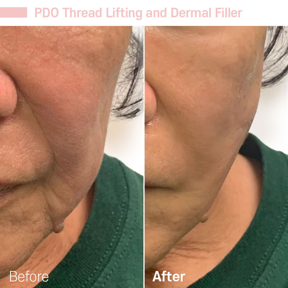PDO Thread Lifting and Dermal Filler — before and after at Jeune Medspa La Habra