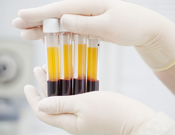 PRP injection treatment at Jeune Medspa La Habra
